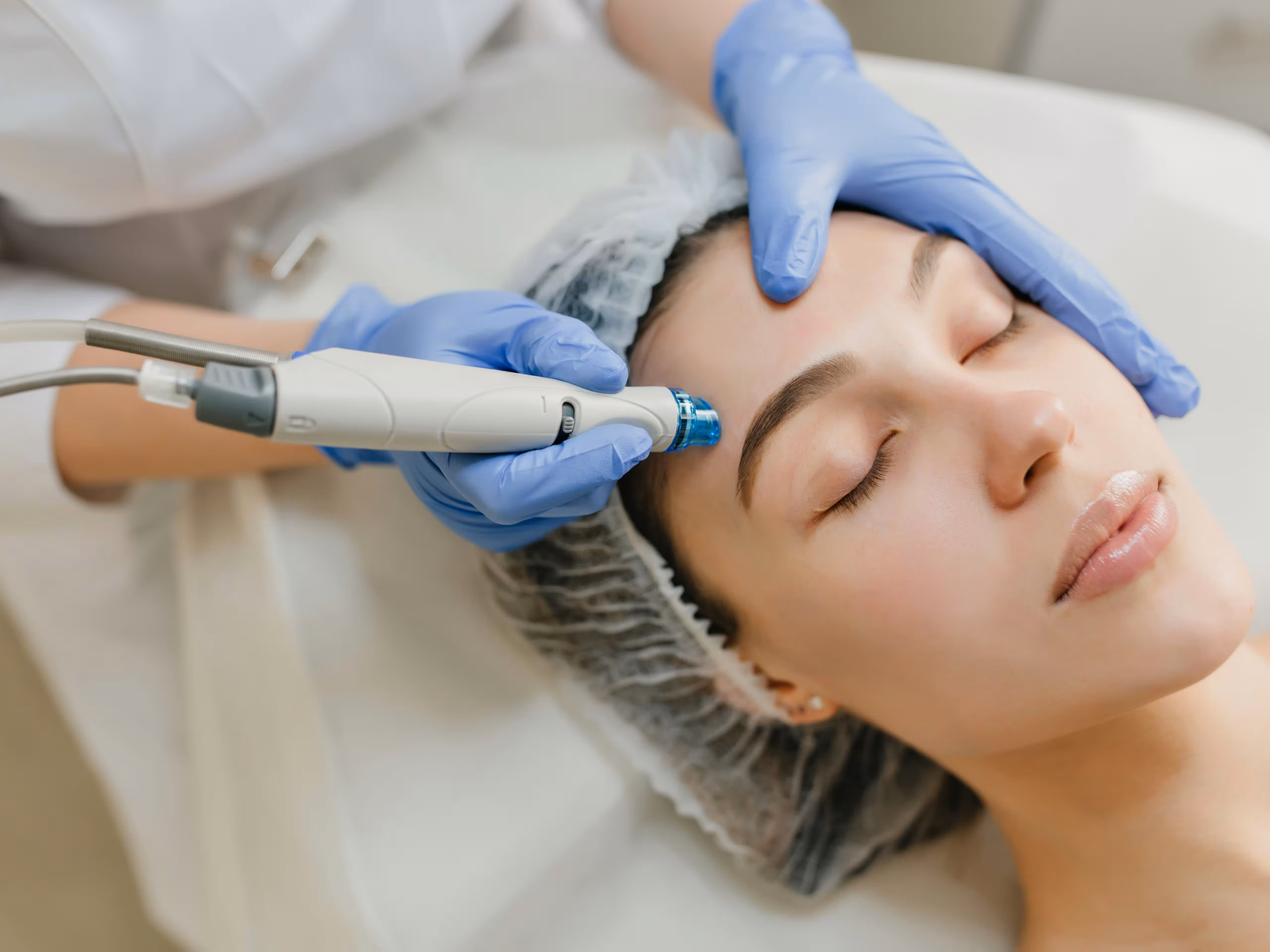 Microneedling-Behandlung in der Praxis Neuheim